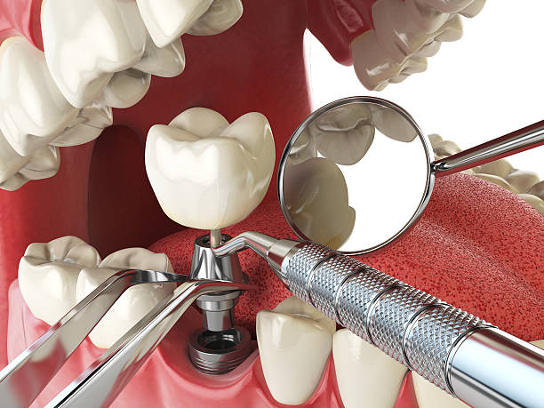 Best Emergency Dentist for Lost Fillings or Crowns in Springfield, VA